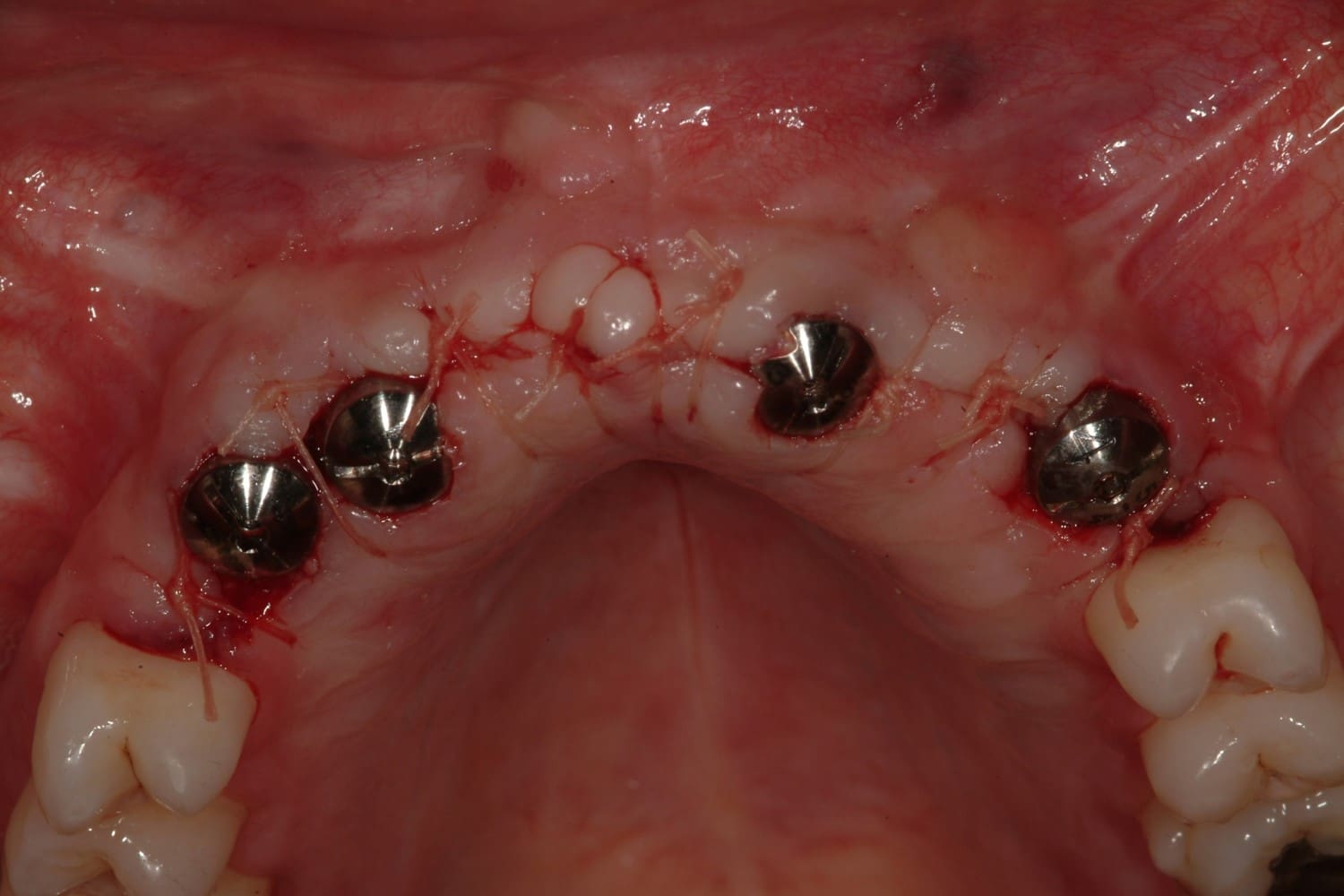 Case 1 Implant Bridge