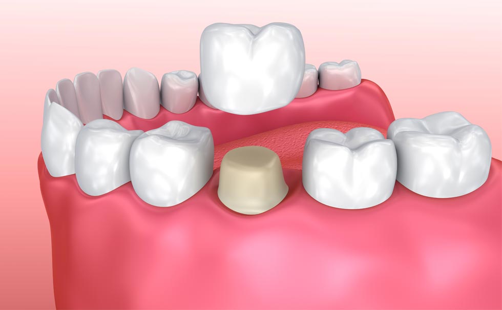 Periodontics treatment Ireland