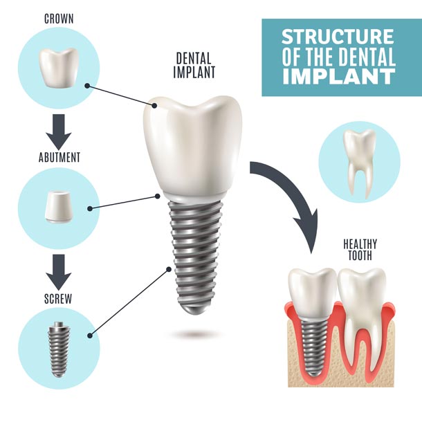 Dental Implants Galway