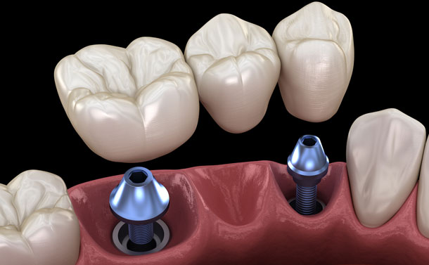 Dental Implants Galway