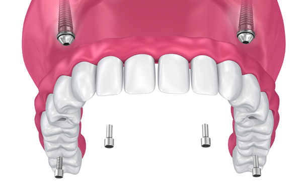 Dental Implants Galway