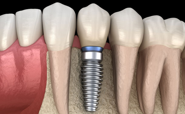 Single tooth implant Galway