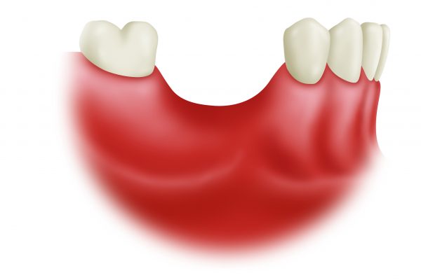 Bone Grafting final#1