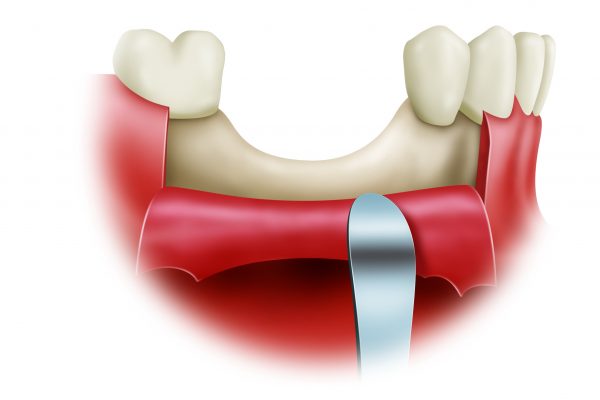 Bone Grafting final#2