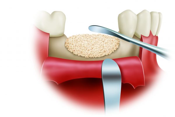 Bone Grafting final#3