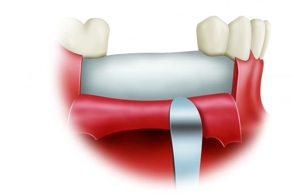 Bone Grafting final#4