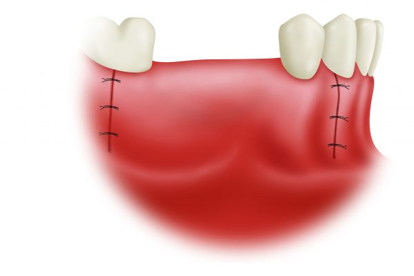 Bone Grafting final#5