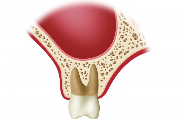 Sinus Lift-Procedure 2.#1