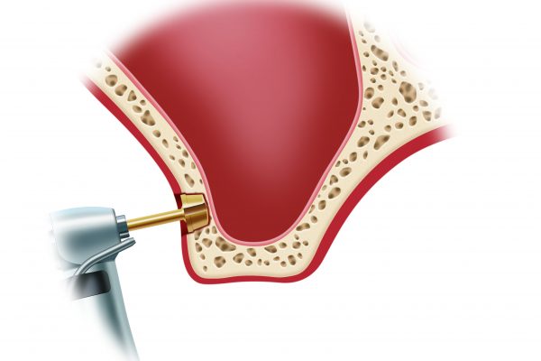 Sinus Lift-Procedure 2.#3