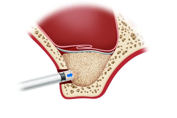 Sinus Lift-Procedure 2.#5