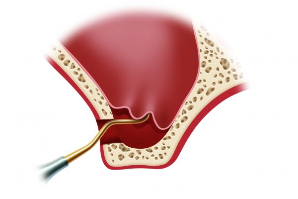 Sinus Lift-Procedure 2#4