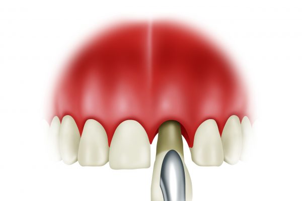 Socket Grafting final#2