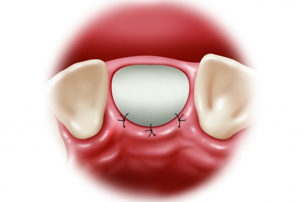 Socket Grafting final#5