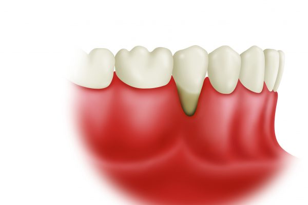 Soft Tissue Grafting final#1