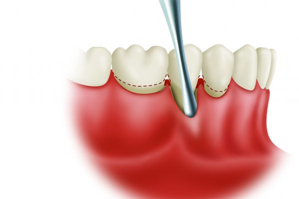 Soft Tissue Grafting final#2