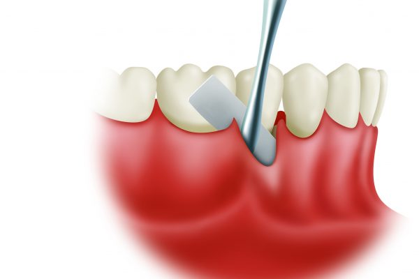 Soft Tissue Grafting final#3