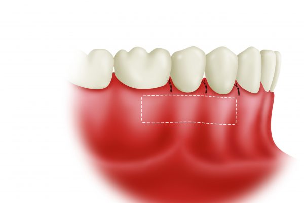 Soft Tissue Grafting final#4